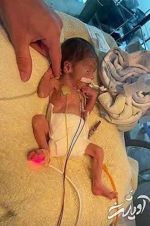 تولد نوزادی با وزن کمتر از 1 کیلو گرم نوزاد نارس